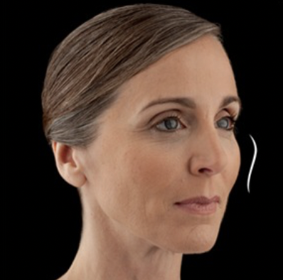 After cheek filler - restored volume and contours
