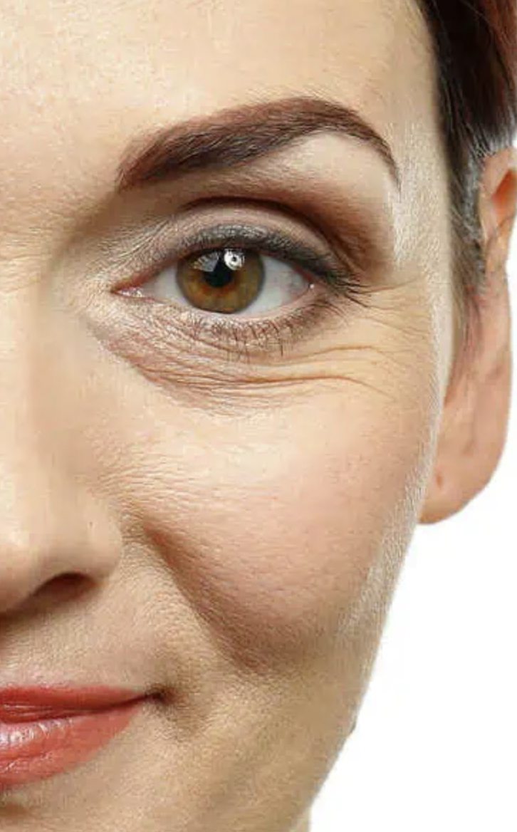 Before eye treatment - visible crow's feet