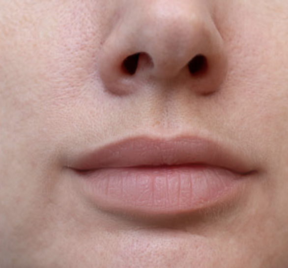 After lip filler - enhanced volume and definition