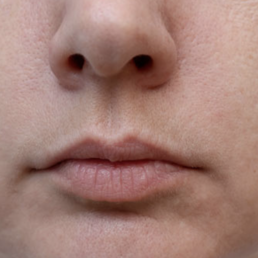 Before lip enhancement - natural lip shape